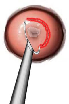 Loop Biopsy Illustration
